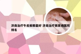 济南治疗牛皮癣那最好 济南治疗银屑病医院排名