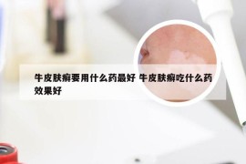 牛皮肤癣要用什么药最好 牛皮肤癣吃什么药效果好