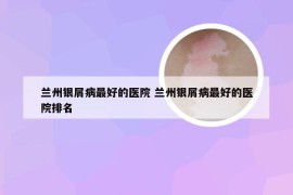 兰州银屑病最好的医院 兰州银屑病最好的医院排名