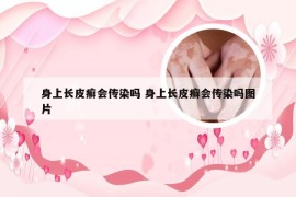 身上长皮癣会传染吗 身上长皮癣会传染吗图片