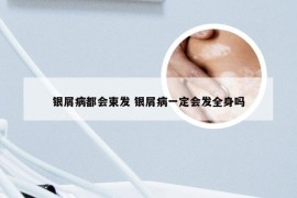 银屑病都会束发 银屑病一定会发全身吗