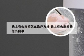 头上有头皮癣怎么治疗方法 头上有头皮癣是怎么回事