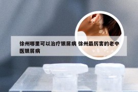徐州哪里可以治疗银屑病 徐州最厉害的老中医银屑病