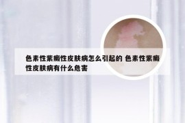 色素性紫癜性皮肤病怎么引起的 色素性紫癜性皮肤病有什么危害