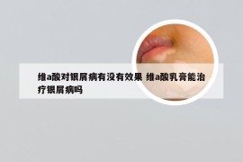 维a酸对银屑病有没有效果 维a酸乳膏能治疗银屑病吗