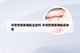寻常性银屑病能治愈吗 寻常性银屑病临床表现
