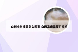 白斑非常痒是怎么回事 白斑发痒是要扩散吗