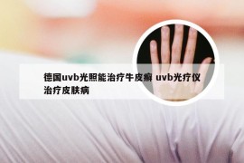 德国uvb光照能治疗牛皮癣 uvb光疗仪治疗皮肤病