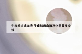 牛皮癣过滤血液 牛皮肤癣血液净化需要多少钱