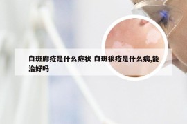白斑廊疮是什么症状 白斑狼疮是什么病,能治好吗