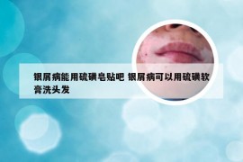银屑病能用硫磺皂贴吧 银屑病可以用硫磺软膏洗头发