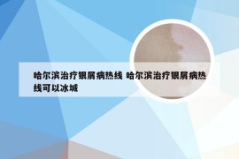 哈尔滨治疗银屑病热线 哈尔滨治疗银屑病热线可以冰城