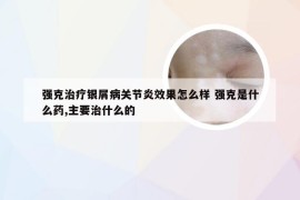 强克治疗银屑病关节炎效果怎么样 强克是什么药,主要治什么的