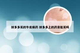 拼多多买的牛皮癣药 拼多多上的药膏能买吗