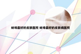 蚌埠最好的皮肤医院 蚌埠最好的皮肤病医院