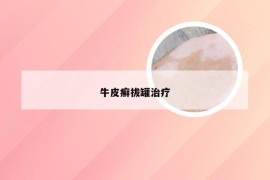 牛皮癣拔罐治疗