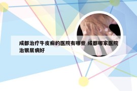 成都治疗牛皮癣的医院有哪些 成都哪家医院治银屑病好