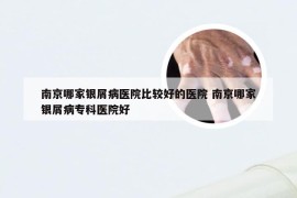 南京哪家银屑病医院比较好的医院 南京哪家银屑病专科医院好