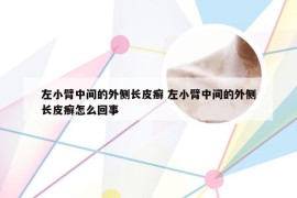 左小臂中间的外侧长皮癣 左小臂中间的外侧长皮癣怎么回事