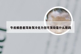 牛皮癣患者浑身发冷无力但不发烧是什么原因