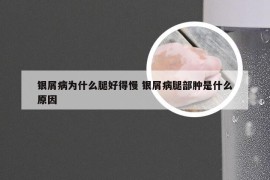 银屑病为什么腿好得慢 银屑病腿部肿是什么原因
