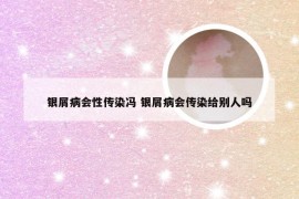银屑病会性传染冯 银屑病会传染给别人吗