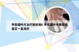 甲氨蝶呤片治疗银屑病6 甲氨蝶呤对银屑病是否一直用药