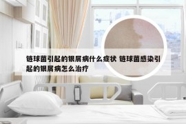 链球菌引起的银屑病什么症状 链球菌感染引起的银屑病怎么治疗