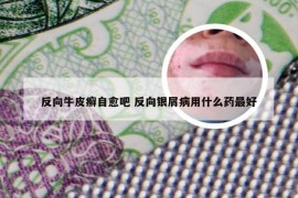 反向牛皮癣自愈吧 反向银屑病用什么药最好