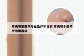 重庆哪家医院专业治疗牛皮癣 重庆哪个医院专治银屑病