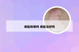 癣能除根吗 癣能治好吗