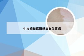 牛皮癣和真菌感染有关系吗
