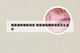 银屑病有哪些症状 银屑病有哪些症状怎么治疗