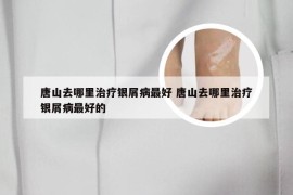 唐山去哪里治疗银屑病最好 唐山去哪里治疗银屑病最好的