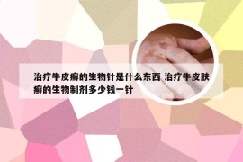 治疗牛皮癣的生物针是什么东西 治疗牛皮肤癣的生物制剂多少钱一针
