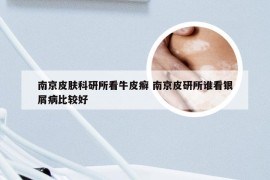 南京皮肤科研所看牛皮癣 南京皮研所谁看银屑病比较好