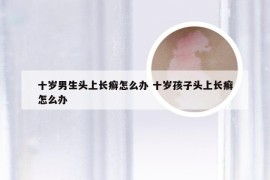 十岁男生头上长癣怎么办 十岁孩子头上长癣怎么办