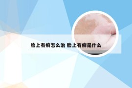 脸上有癣怎么治 脸上有癣是什么