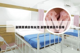 副银屑病会有水泡 副银屑病会不会痒