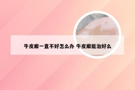 牛皮廨一直不好怎么办 牛皮廨能治好么