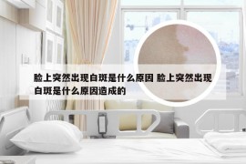 脸上突然出现白斑是什么原因 脸上突然出现白斑是什么原因造成的