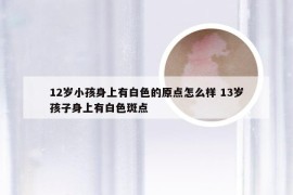 12岁小孩身上有白色的原点怎么样 13岁孩子身上有白色斑点