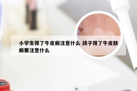 小学生得了牛皮癣注意什么 孩子得了牛皮肤癣要注意什么