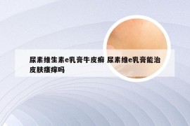 尿素维生素e乳膏牛皮癣 尿素维e乳膏能治皮肤瘙痒吗