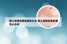 婴儿有脓包银屑病怎么办 婴儿有脓包银屑病怎么办啊