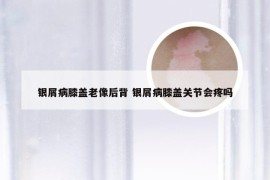 银屑病膝盖老像后背 银屑病膝盖关节会疼吗