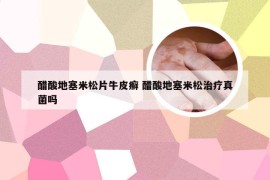 醋酸地塞米松片牛皮癣 醋酸地塞米松治疗真菌吗