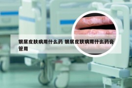 银屑皮肤病用什么药 银屑皮肤病用什么药膏管用