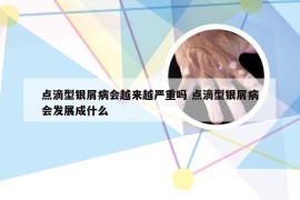 点滴型银屑病会越来越严重吗 点滴型银屑病会发展成什么