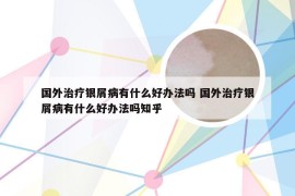 国外治疗银屑病有什么好办法吗 国外治疗银屑病有什么好办法吗知乎